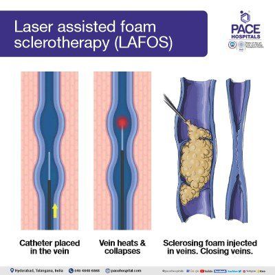 Laser assisted foam sclerotherapy (LAFOS) varicose veins treatment in hyderabad | varicose vein surgery