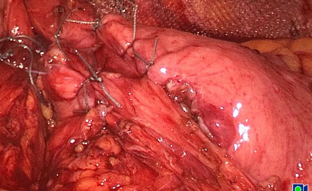 Image of Bochdalek Hernia