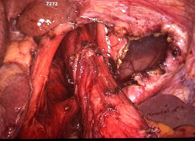 Image of Bochdalek Hernia