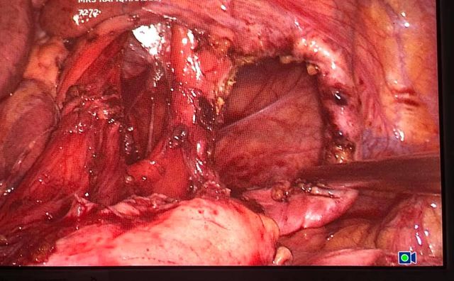 Image of Bochdalek Hernia