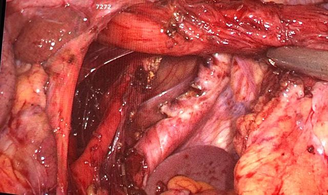 Image of Bochdalek Hernia