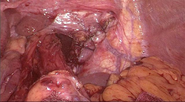 Image of Bochdalek Hernia
