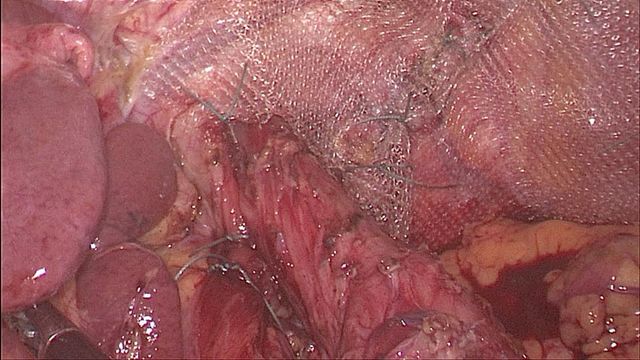 Image of Bochdalek Hernia