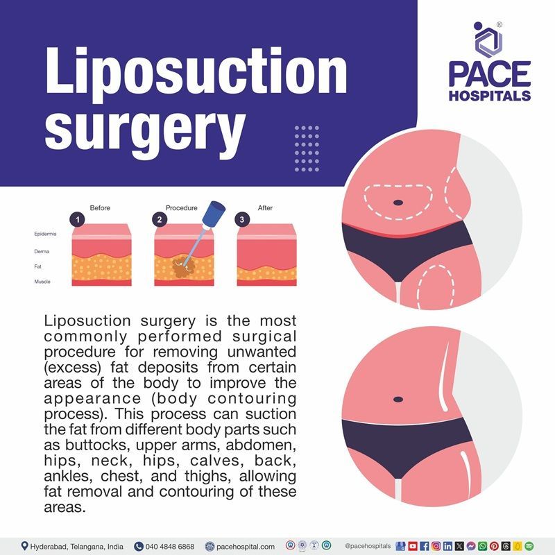 best liposuction hospital in Hyderabad | liposuction meaning | liposuction cost in Hyderabad | best liposuction in Hyderabad | liposuction near me