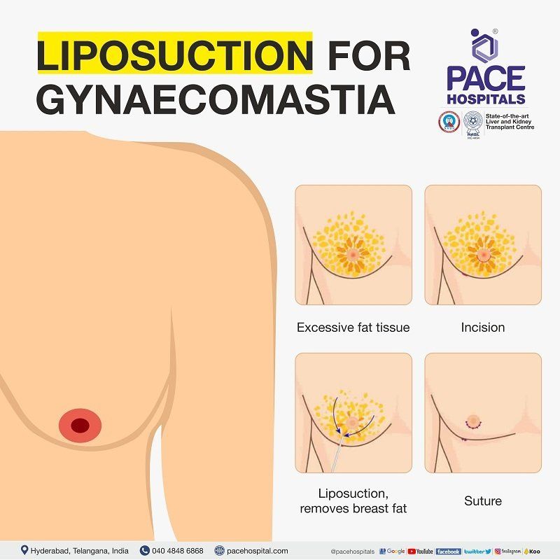 Liposuction in Hyderabad | Liposuction for gynecomastia in India