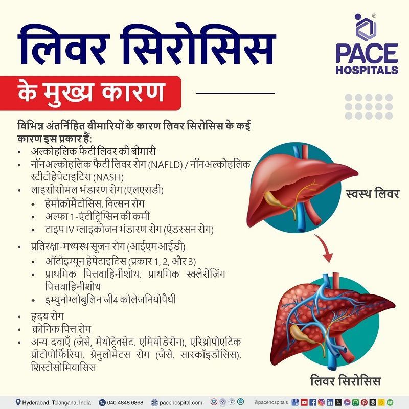 liver cirrhosis causes in hindi | biliary cirrhosis in hindi | liver cirrhosis in hindi meaning