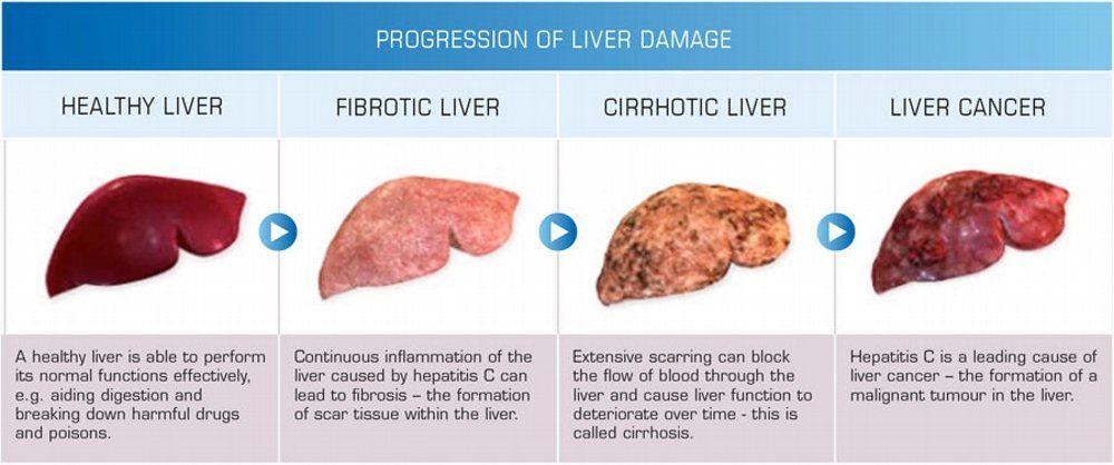 progress of liver disease liver