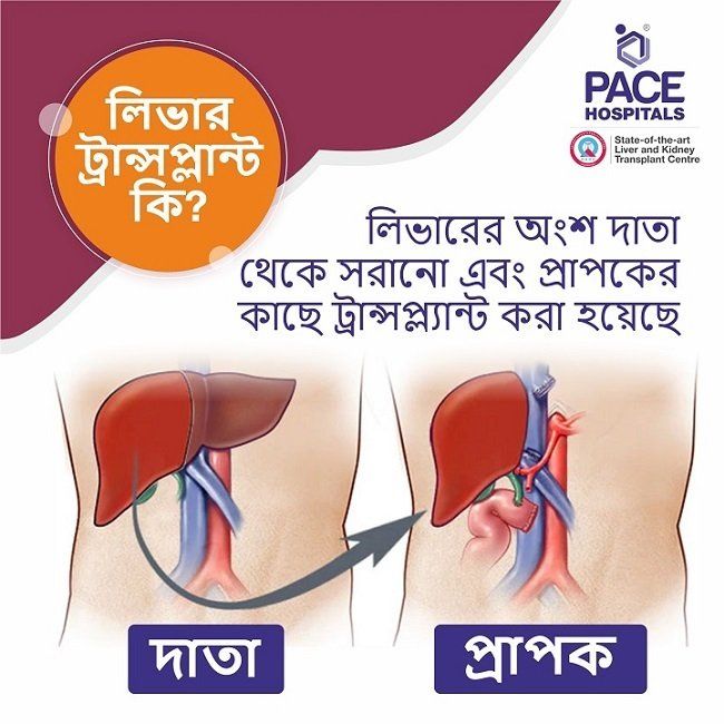 Liver Transplant in Bengali | বাংলায় লিভার ট্রান্সপ্লান্ট