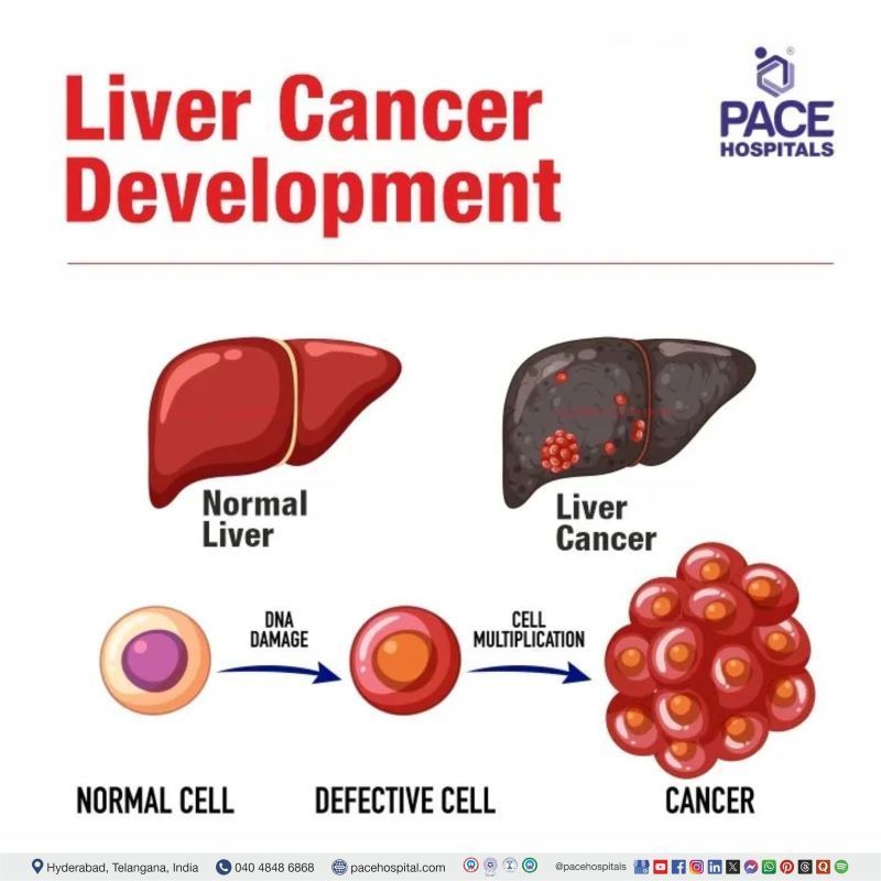 Liver cancer | Liver Cancer Development