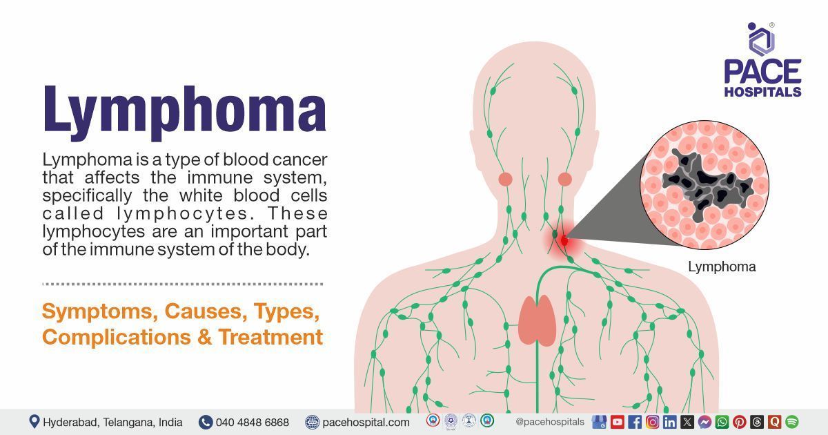 What is lymphoma cancer​ | what is hodgkin's lymphoma | lymphoma treatment in India