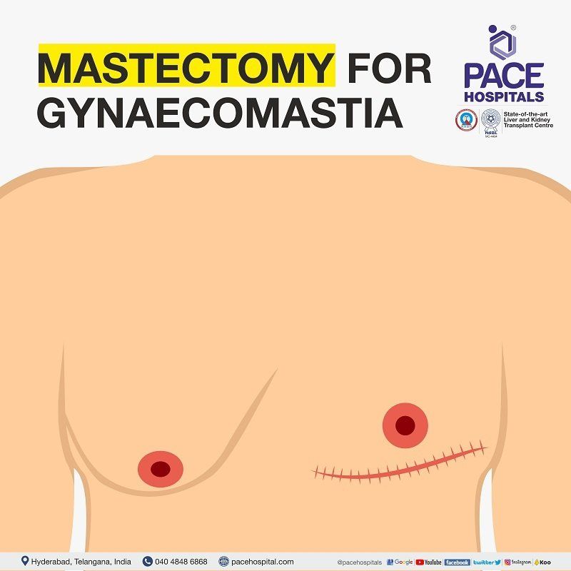 Mastectomy in Hyderabad | mastectomy for gynecomastia in India | Mastectomy surgery | Double mastectomy | male chest reduction | men breast reduction | man boob removal | breast reduction surgery in men