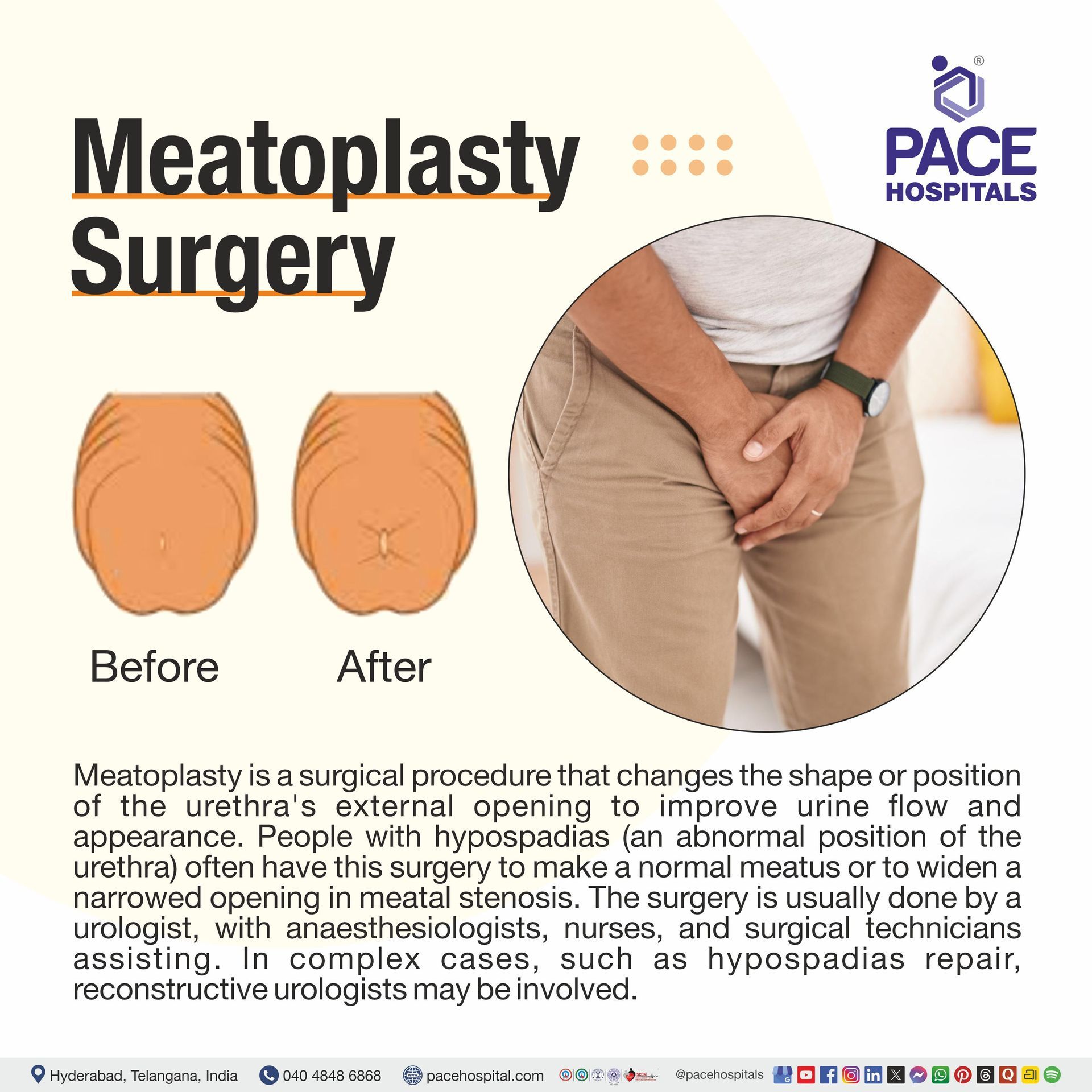 Meatoplasty meaning | Meatoplasty Procedure | what is meatolplasty surgery