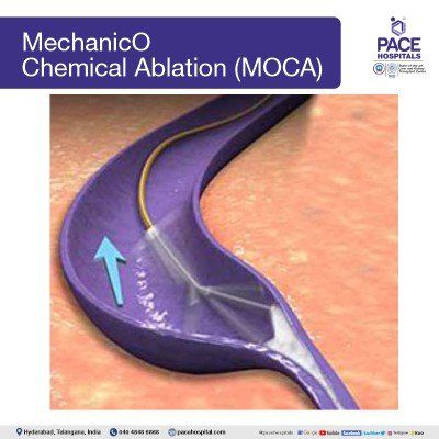 mechanico chemical ablation (MOCA) for varicose veins treatment in hyderabad in hyderabad | varicose vein surgery
