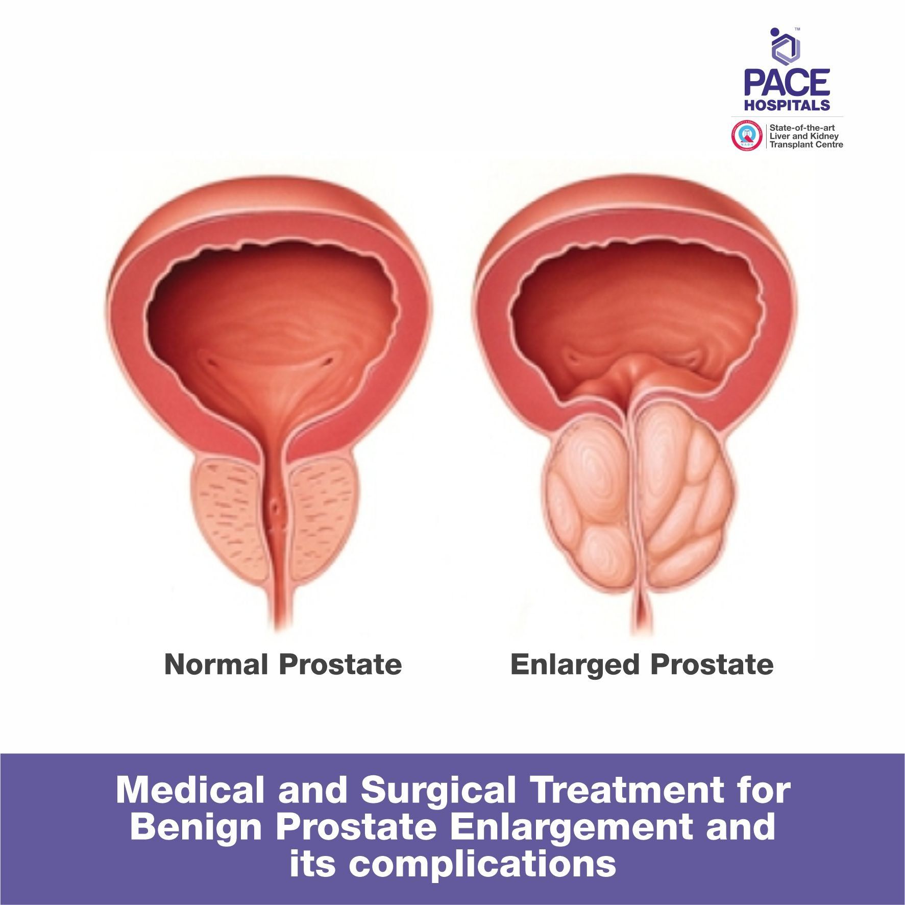 Medical and Surgical Treatment for Benign Prostate Enlargement and its complications