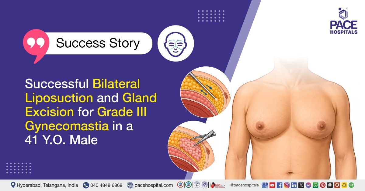 Successful bilateral liposuction & gland excision done for Grade 3 Gynecomastia at PACE Hospitals.