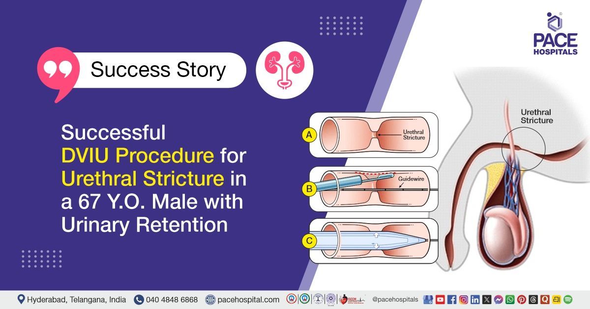DVIU Procedure done for Urethral Stricture treatment at PACE Hospitals