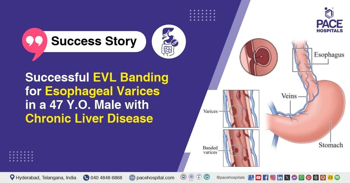 Successful Endoscopic Variceal Ligation done for Esophageal Varices Treatment at PACE Hospitals