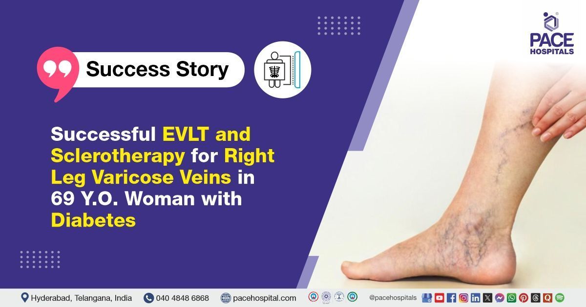 Successful EVLT & Sclerotherapy done for Right Leg Varicose Veins with Diabetes at PACE Hospitals 