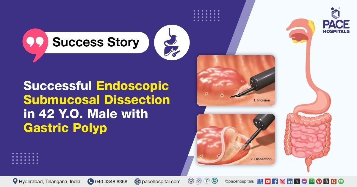Successful ESD procedure done for gastric polyp removal at PACE Hospitals, Hyderabad