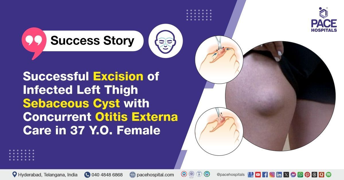 Successful Incision & Drainage and Excision done for infected thigh sebaceous cyst at PACE Hospitals