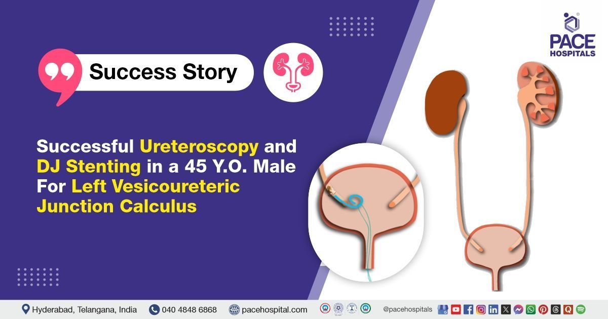Successful Ureteroscopy and DJ Stenting done for Left VUJ Calculus at PACE Hospitals