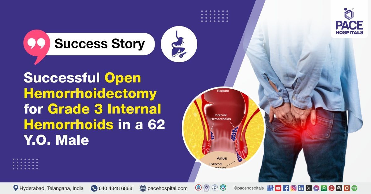 Successful open hemorrhoidectomy done for Grade 3 internal hemorrhoids at PACE Hospitals