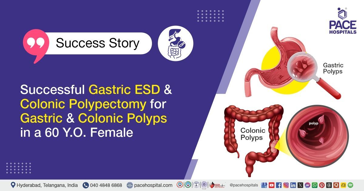 Successful Gastric ESD and Colonic Polypectomy in a 60 Y.O. Female at PACE Hospitals