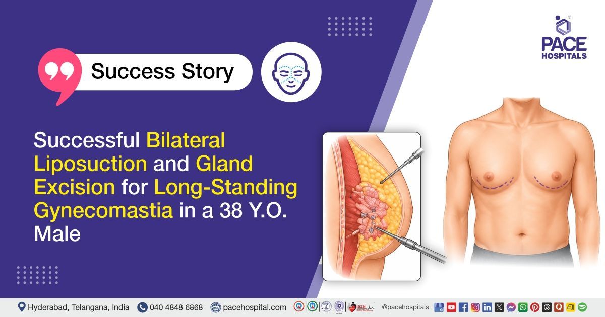 Successful bilateral liposuction and gland excision for Grade 2B gynecomastia at PACE Hospitals