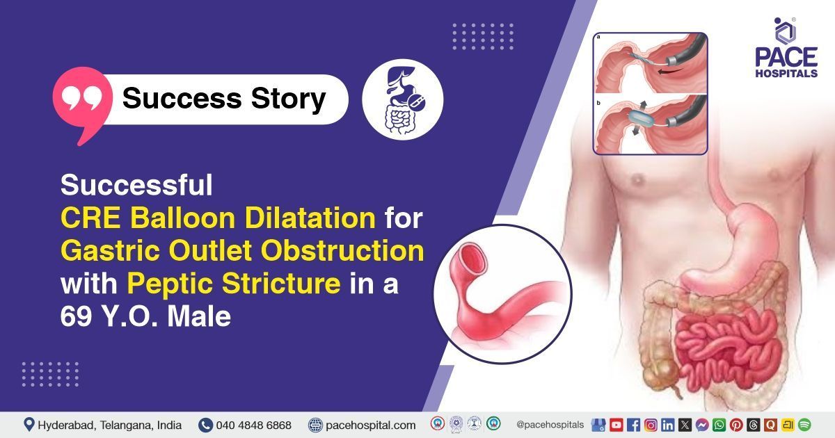 Successful CRE balloon dilatation done for gastric outlet obstruction at PACE Hospitals