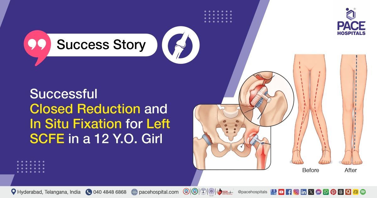 Successful treatment of SCFE and genu valgus with closed reduction, fixation & hemiepiphysiodesis