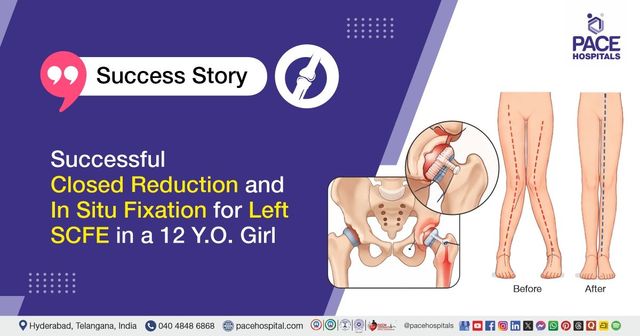 Successful treatment of SCFE and genu valgus with closed reduction, fixation & hemiepiphysiodesis