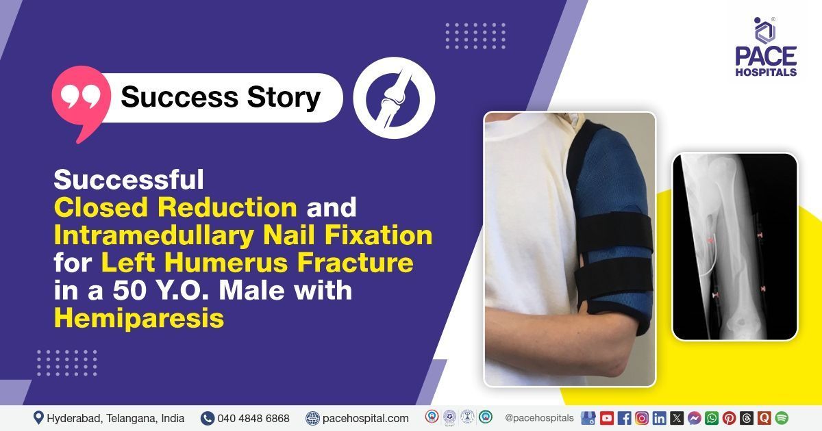 Successful closed reduction and intramedullary nailing done for humerus fracture at PACE Hospitals