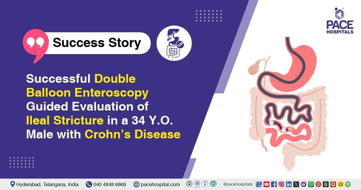 Successful double balloon enteroscopy for ileal stricture in Crohn’s disease at PACE Hospitals