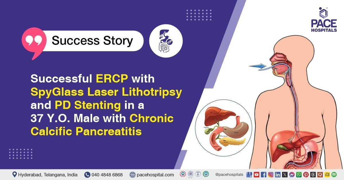 Successful ERCP with SpyGlass Laser Lithotripsy for Chronic Calcific Pancreatitis at PACE Hospitals