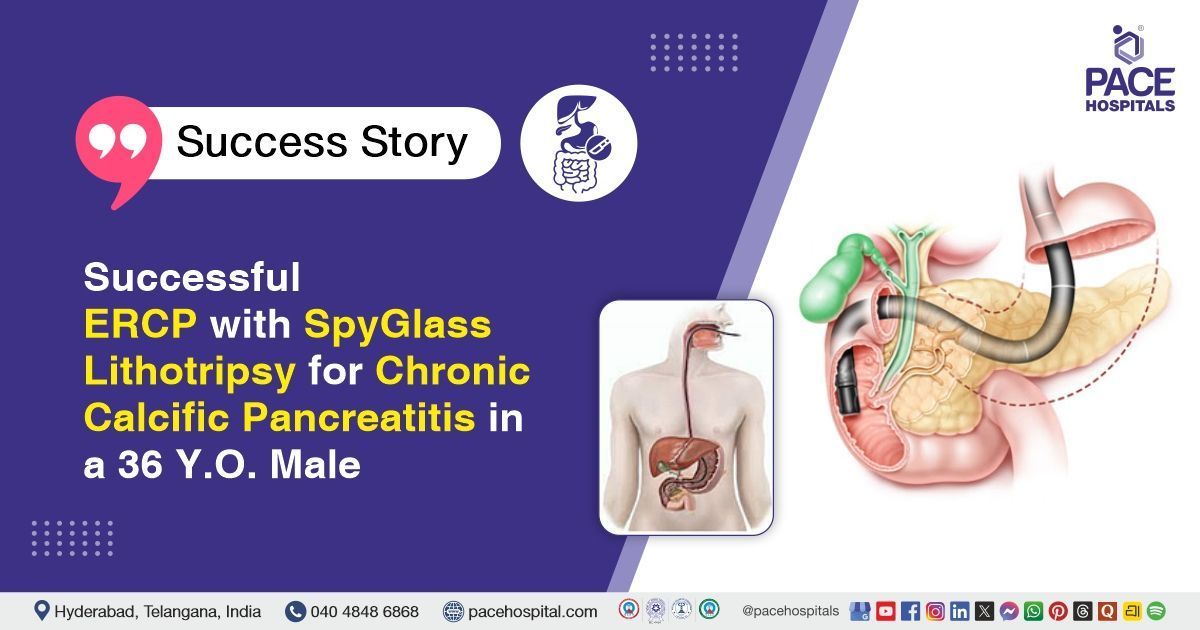 Successful ERCP with SpyGlass Lithotripsy done for Chronic Calcific Pancreatitis at PACE Hospitals