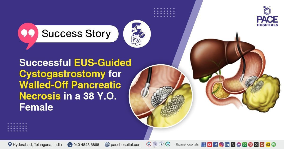 Successful EUS-guided cystogastrostomy done for walled-off pancreatic necrosis at PACE Hospitals