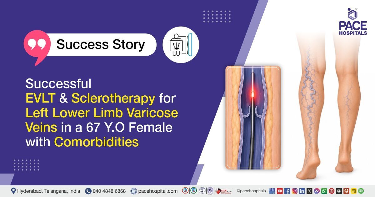Successful EVLT and sclerotherapy for left leg varicose veins treatment at PACE Hospitals