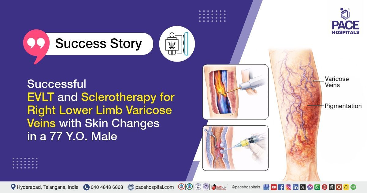 Successful EVLT and Sclerotherapy for Varicose Veins in a 77 Y.O. Male at PACE Hospitals