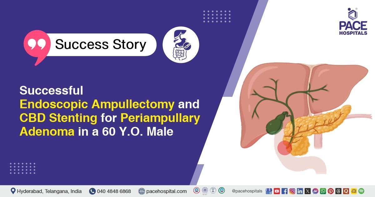 Successful endoscopic ampullectomy and CBD stenting done for periampullary adenoma at PACE Hospitals