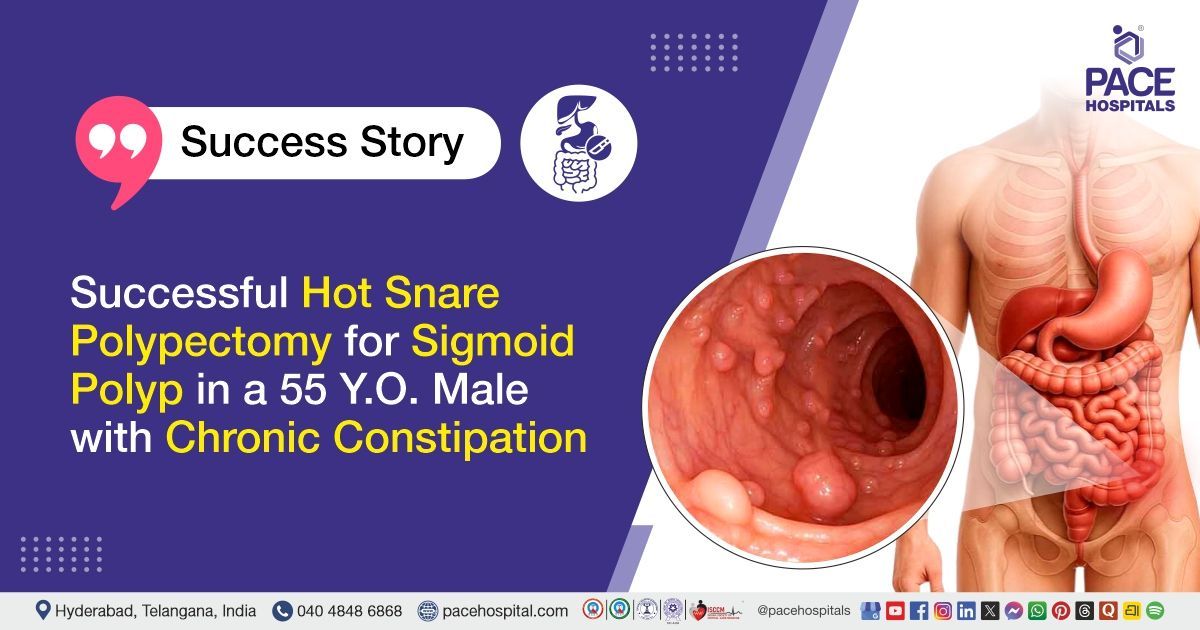 Successful Hot Snare Polypectomy for Sigmoid Polyp treatment in a 55 Y.O. Male at PACE Hospitals