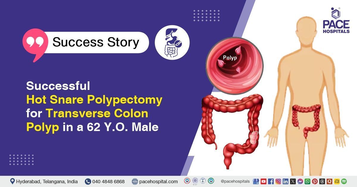 Successful hot snare polypectomy for transverse colon polyp at PACE Hospitals