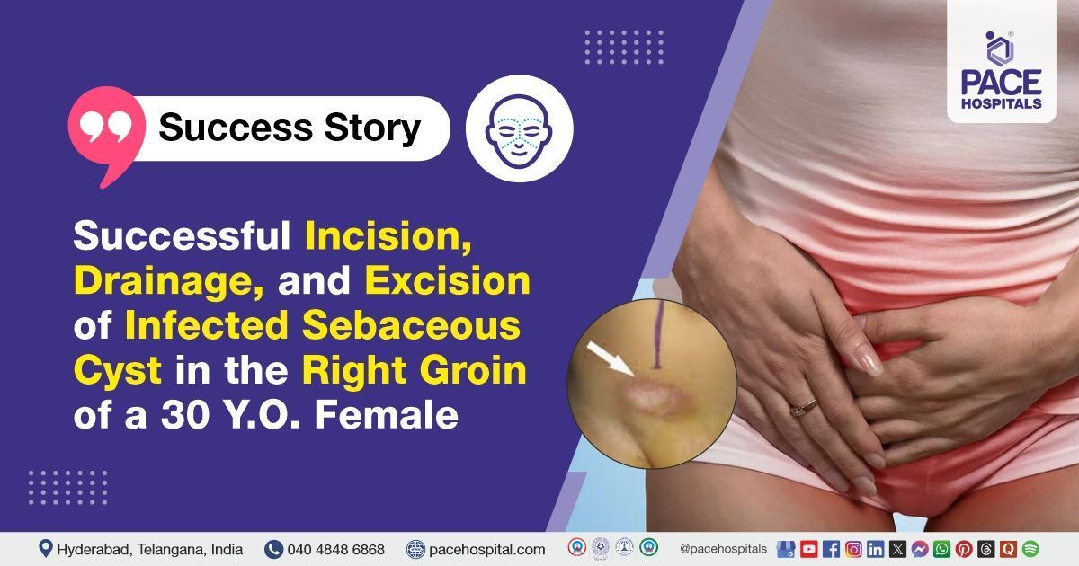 Successful incision, excision and drainage for infected groin sebaceous cyst at PACE Hospitals