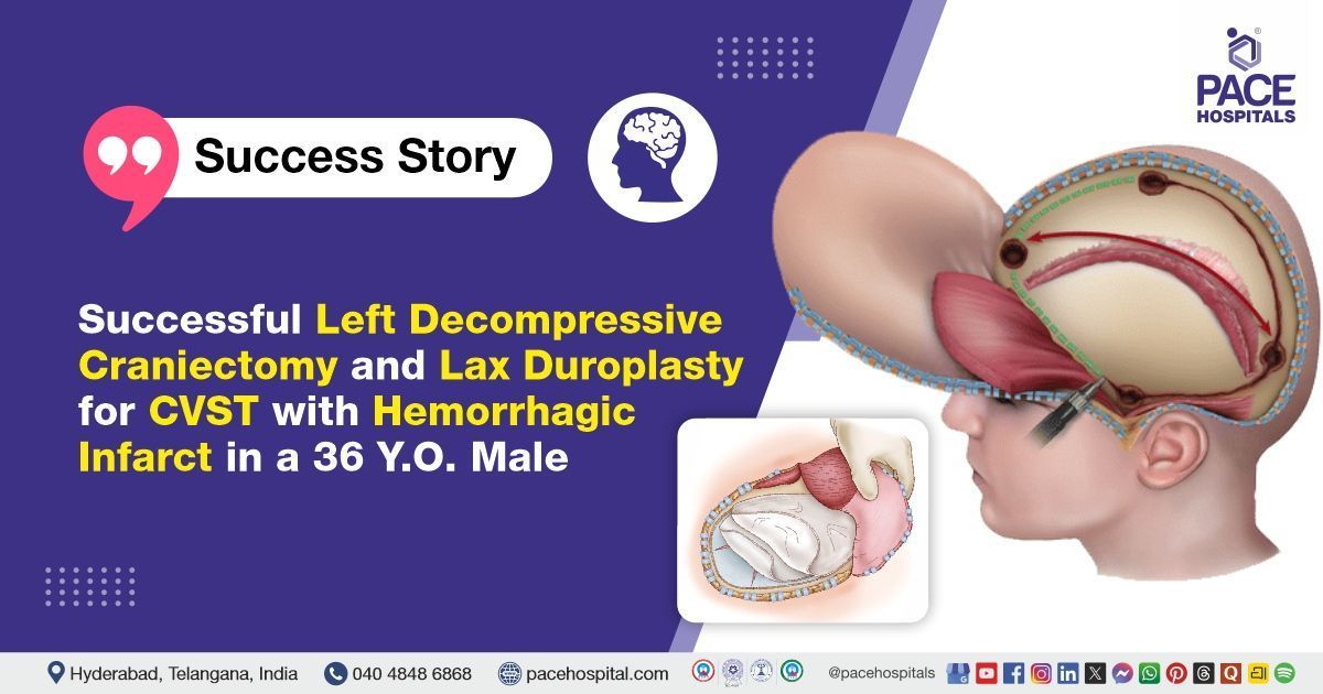 Successful decompressive craniectomy with lax duroplasty done for CVST treatment at PACE Hospitals