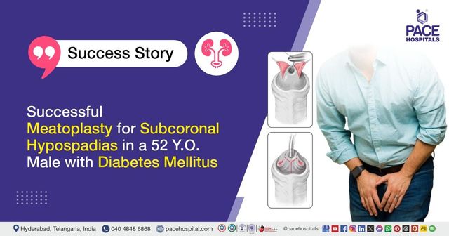 Successful meatoplasty for subcoronal hypospadias in a 52 Y.O. male by urologists at PACE Hospitals
