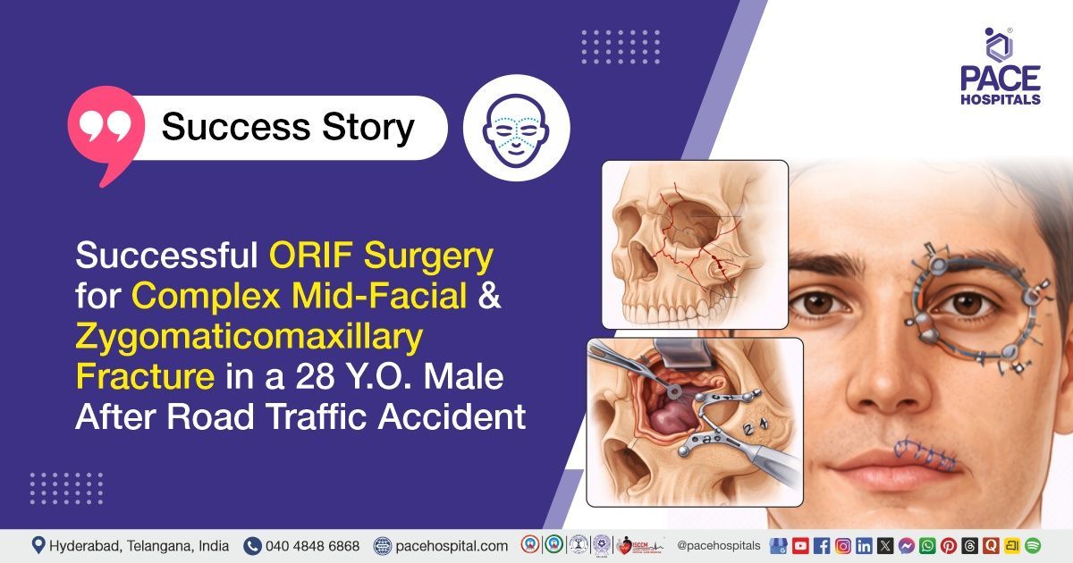 Successful ORIF Surgery for Zygomaticomaxillary Fracture in a 28-Year-Old Male at PACE Hospitals