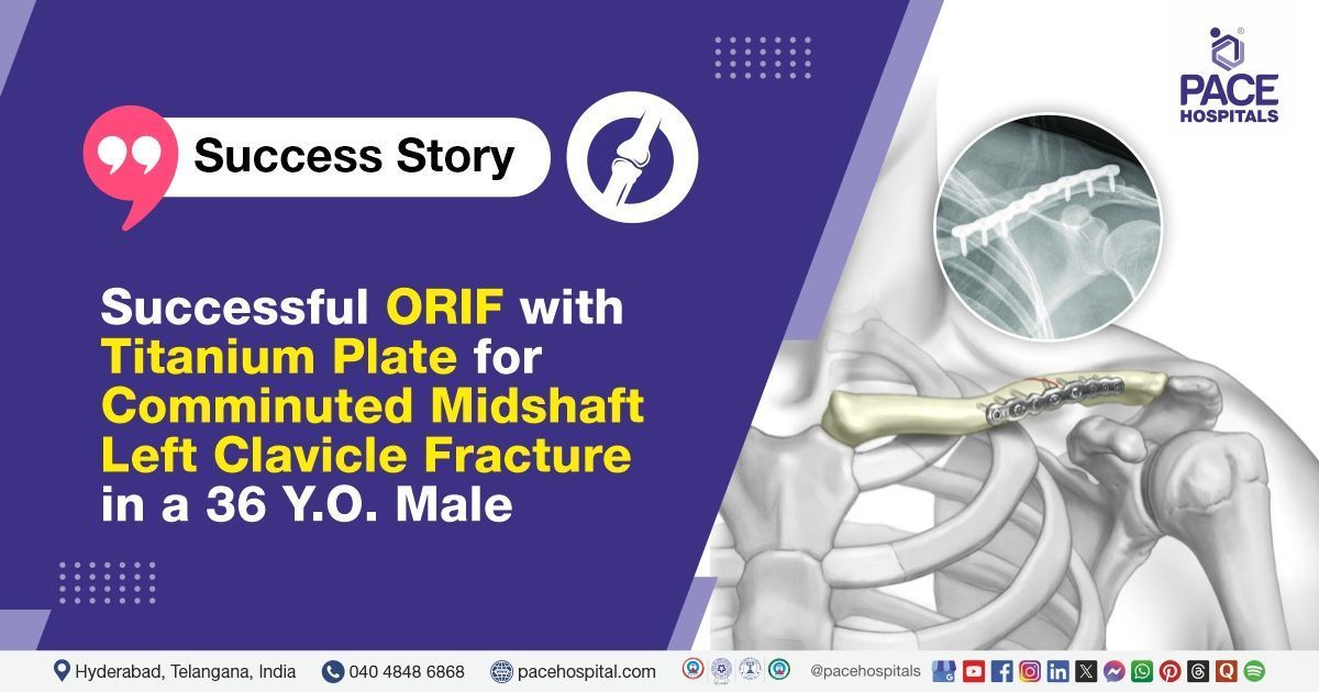 Successful ORIF with titanium plate for comminuted midshaft left clavicle fracture at PACE Hospitals