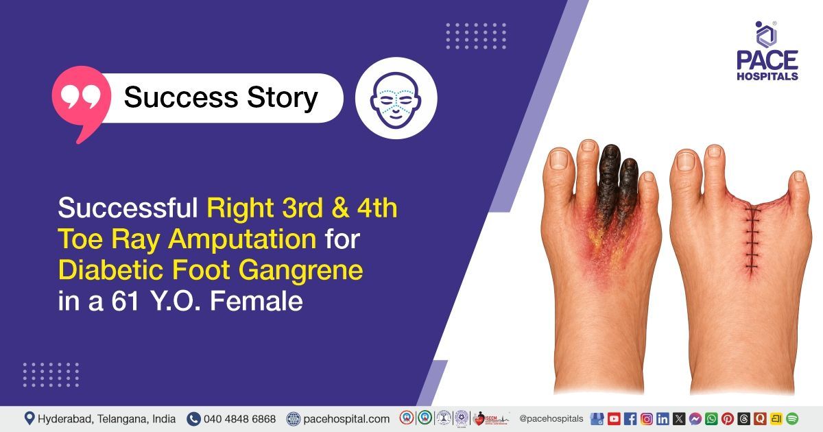 Successful Toe Ray Amputation for Diabetic Foot Cellulitis with Gangrene at PACE Hospitals