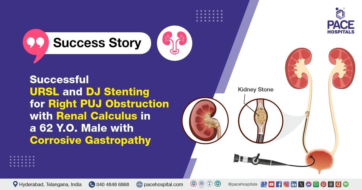 Successful URSL and DJ stenting done for PUJ obstruction with renal stone at PACE Hospitals