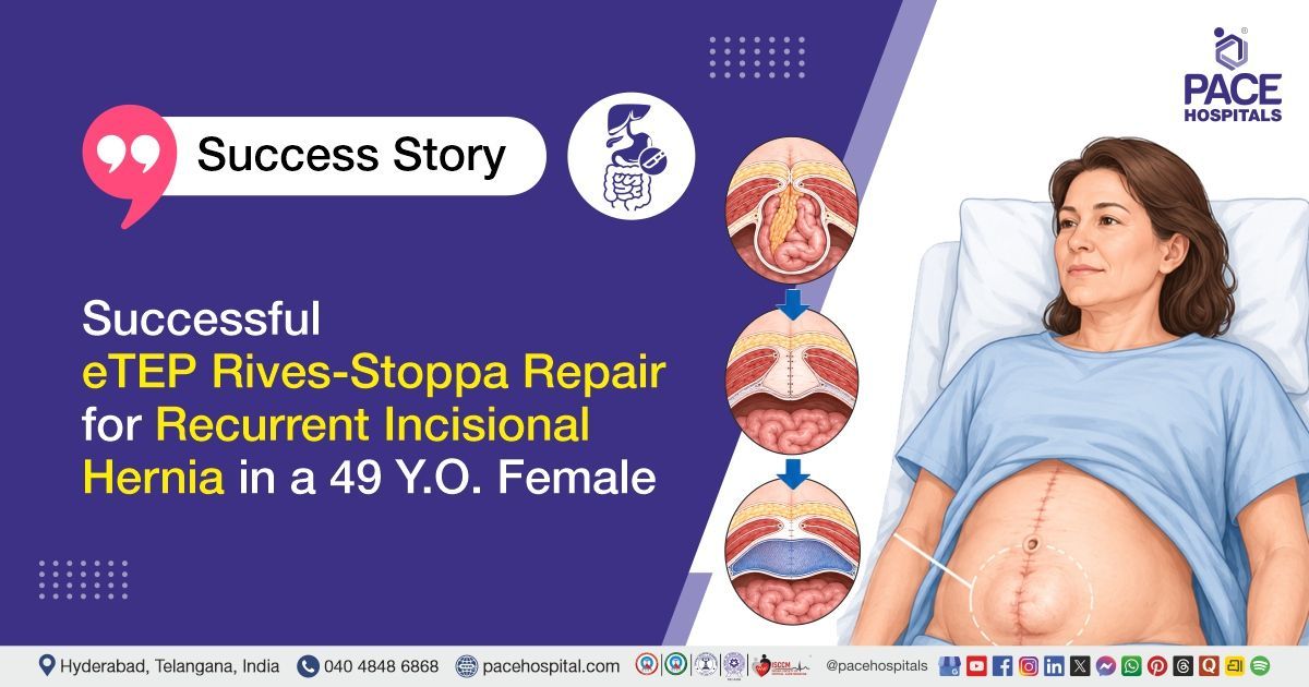 Successful eTEP Rives-Stoppa repair for recurrent incisional hernia treatment at PACE Hospitals