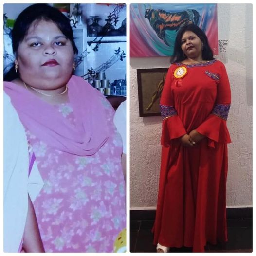 REVISION BARIATRIC SURGERY Before 168 Kg - After 80 Kg